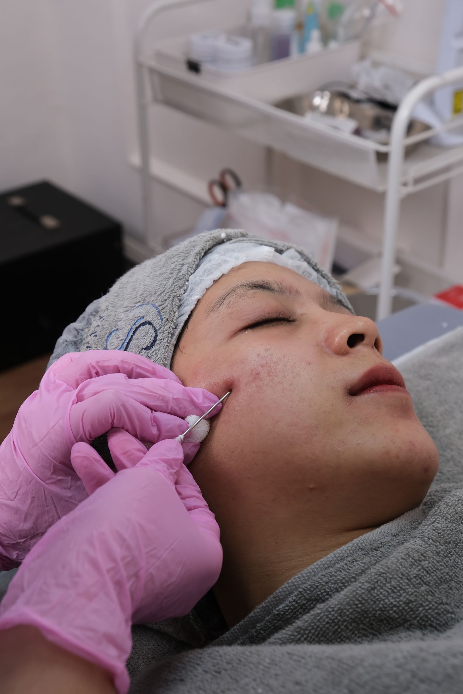 Séance réelle de microneedling sur la joue